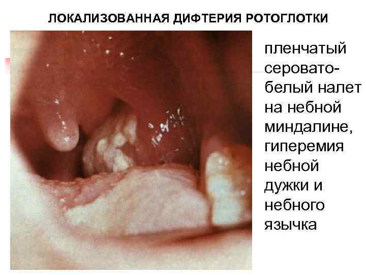 ЛОКАЛИЗОВАННАЯ ДИФТЕРИЯ РОТОГЛОТКИ пленчатый сероватобелый налет на небной миндалине, гиперемия небной дужки и небного
