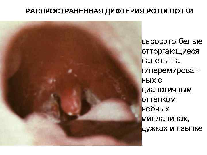 РАСПРОСТРАНЕННАЯ ДИФТЕРИЯ РОТОГЛОТКИ серовато-белые отторгающиеся налеты на гиперемированных с цианотичным оттенком небных миндалинах, дужках