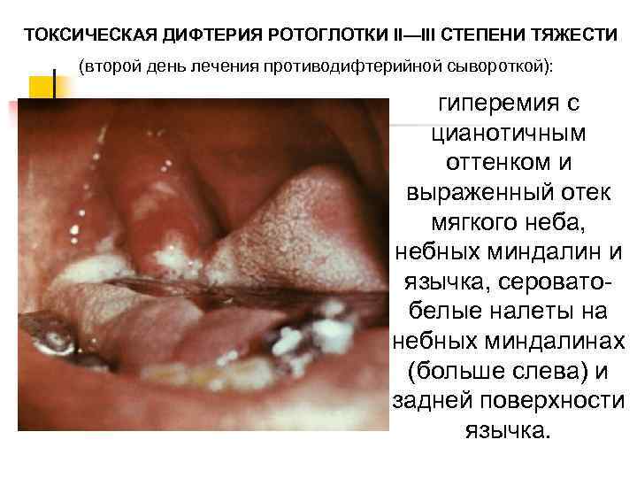 Дифтерия ротоглотки у детей фото