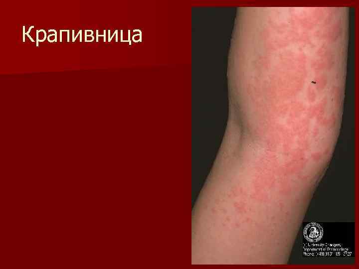 Крапивница 