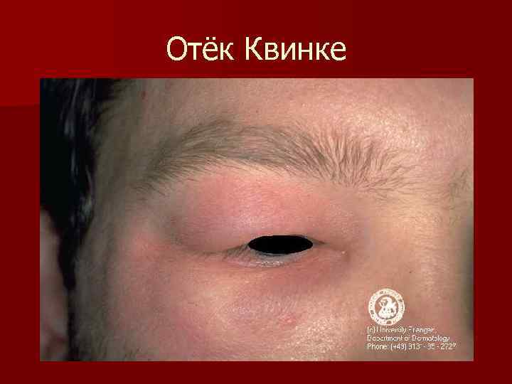 Отёк Квинке 