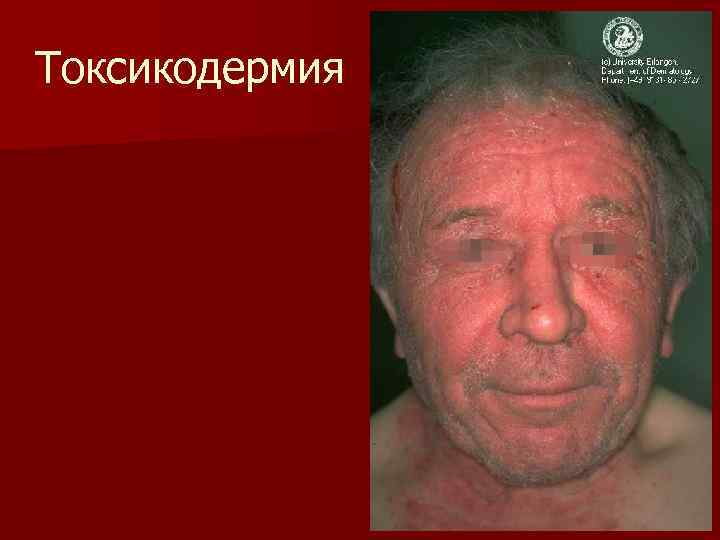 Токсикодермия 