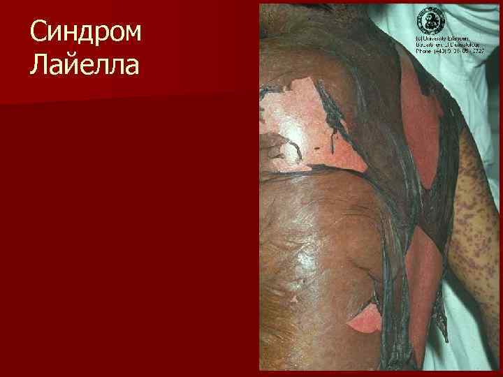 Синдром Лайелла 