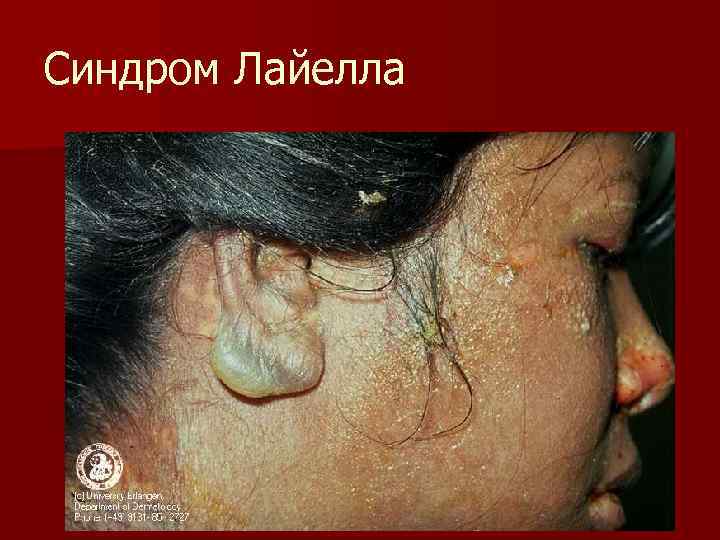 Синдром Лайелла 