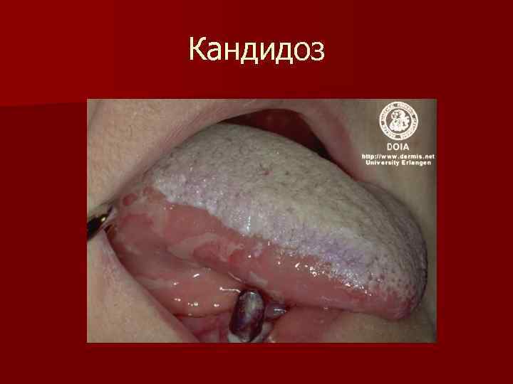Кандидоз 