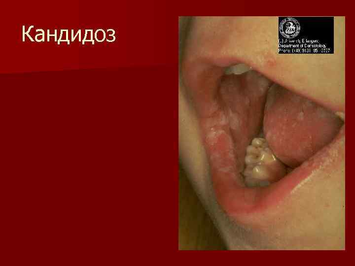 Кандидоз 