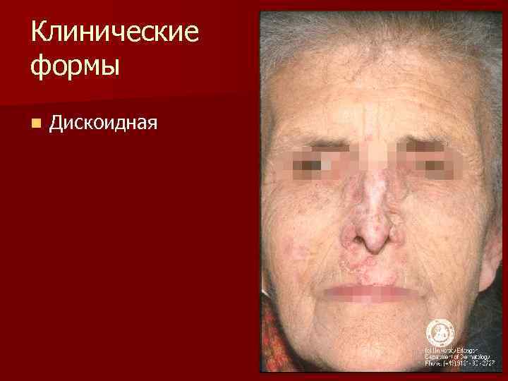 Клинические формы n Дискоидная 
