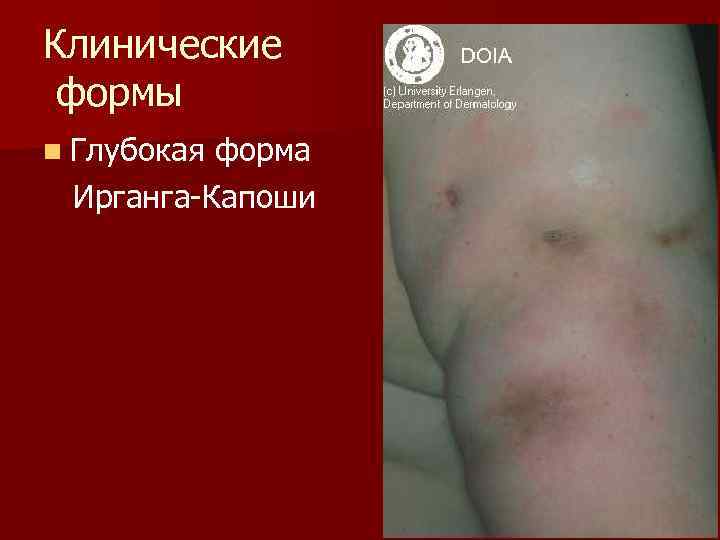 Клинические формы n Глубокая форма Ирганга-Капоши 