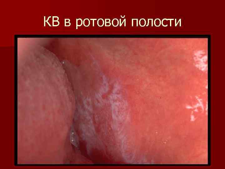 КВ в ротовой полости 