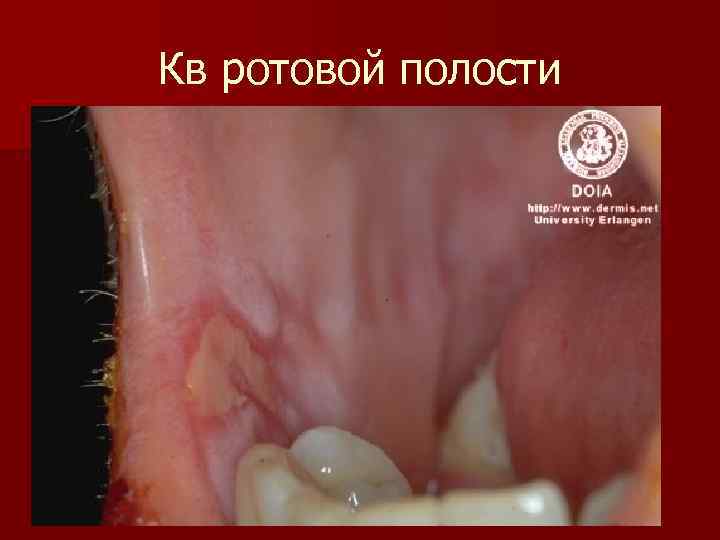 Кв ротовой полости 