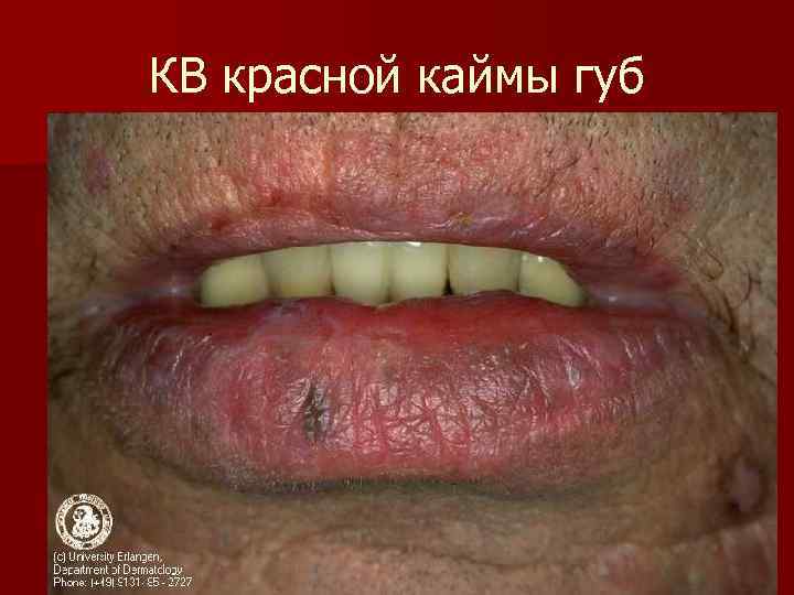 КВ красной каймы губ 