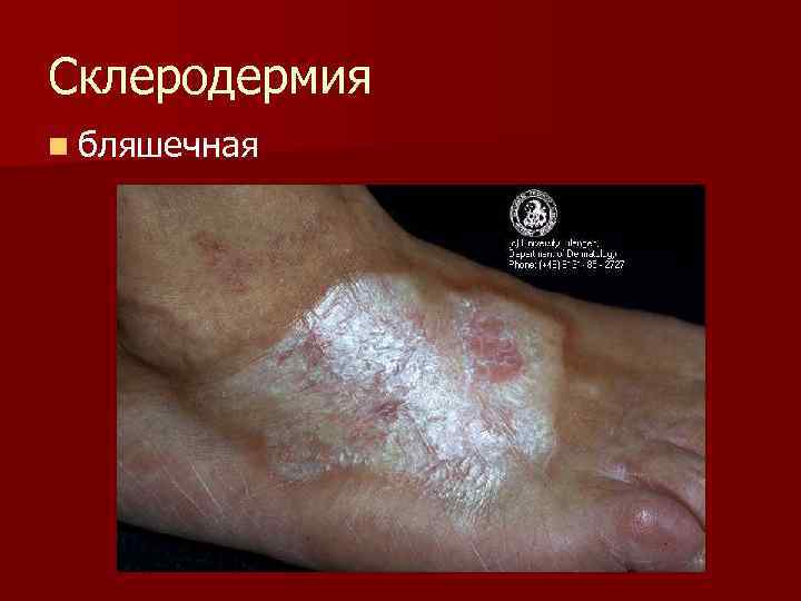 Склеродермия n бляшечная 