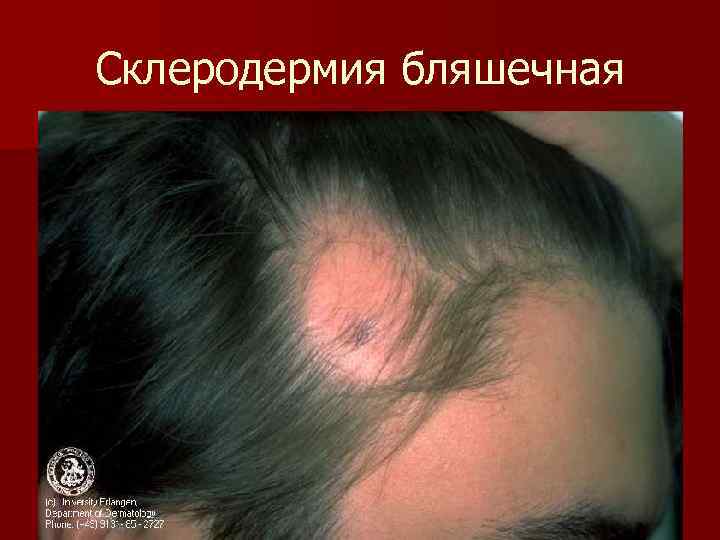 Склеродермия бляшечная 