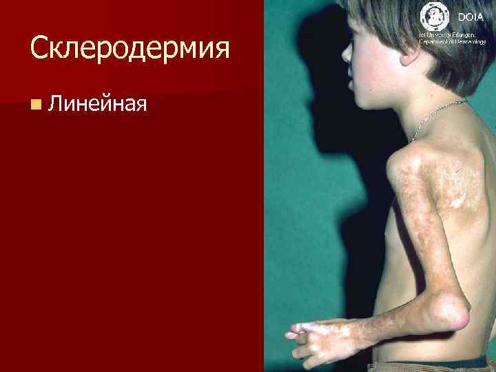 Склеродермия n Линейная 