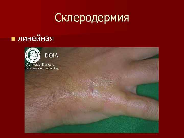 Склеродермия n линейная 