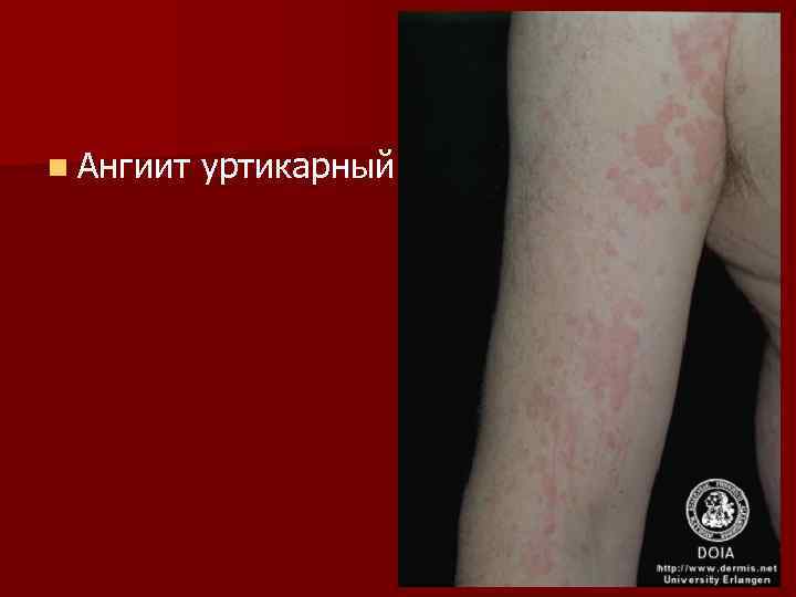 n Ангиит уртикарный 