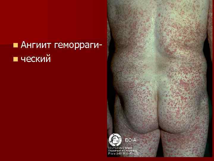 n Ангиит n ческий геморраги- 