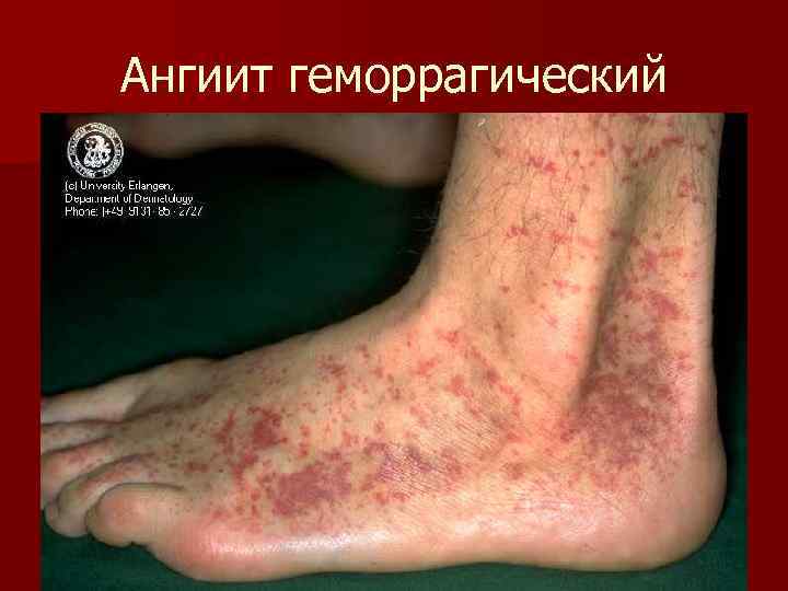 Ангиит геморрагический 