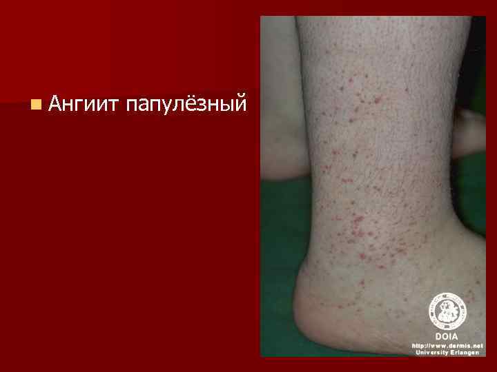 n Ангиит папулёзный 