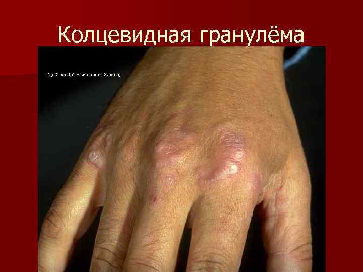 Колцевидная гранулёма 