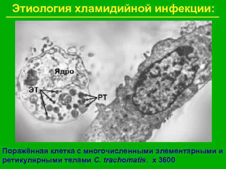 Этиология хламидийной инфекции: Поражённая клетка с многочисленными элементарными и ретикулярными телами C. trachomatis. х