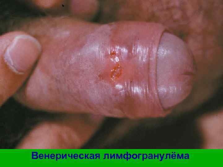 Венерическая лимфогранулёма 