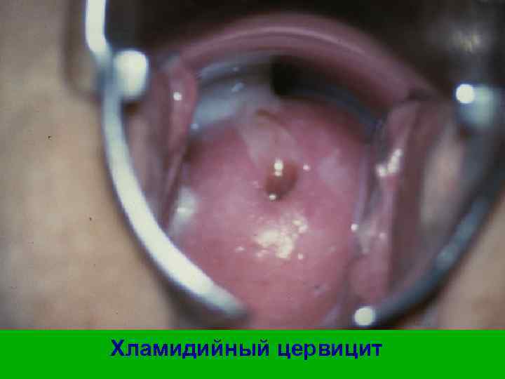 Хламидийный цервицит 