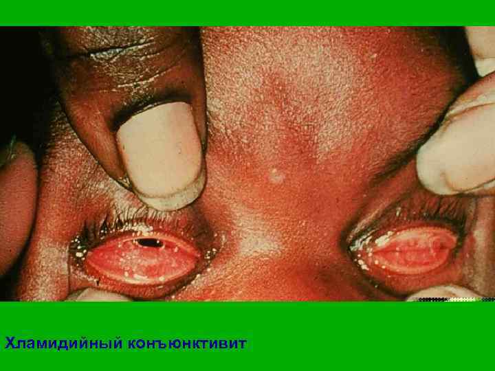 Хламидийный конъюнктивит 