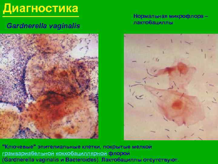 Диагностика Gardnerella vaginalis Нормальная микрофлора – лактобациллы 