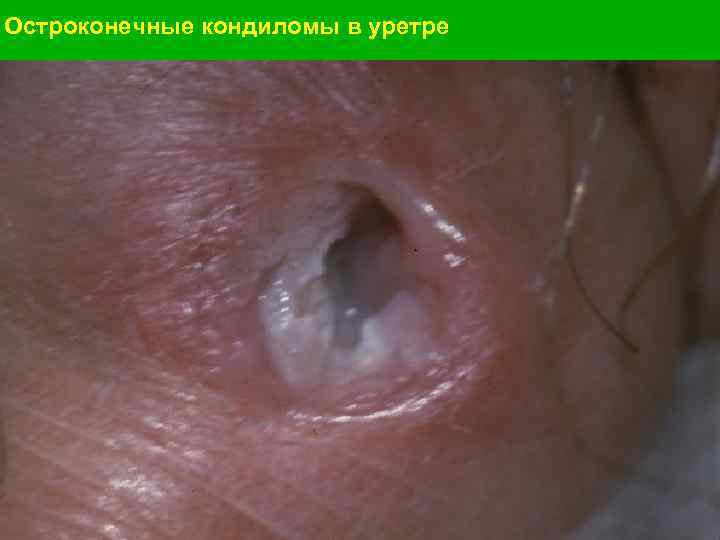 Остроконечные кондиломы в уретре 
