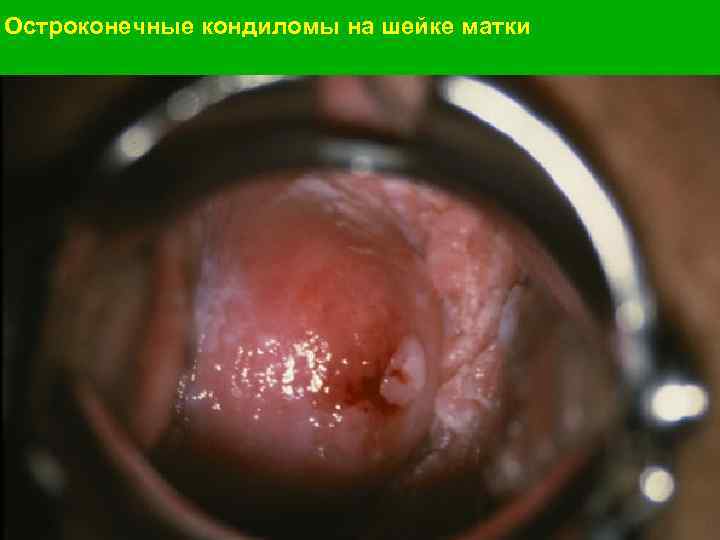 Остроконечные кондиломы на шейке матки 