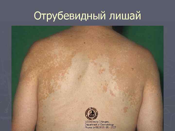 Отрубевидный лишай 