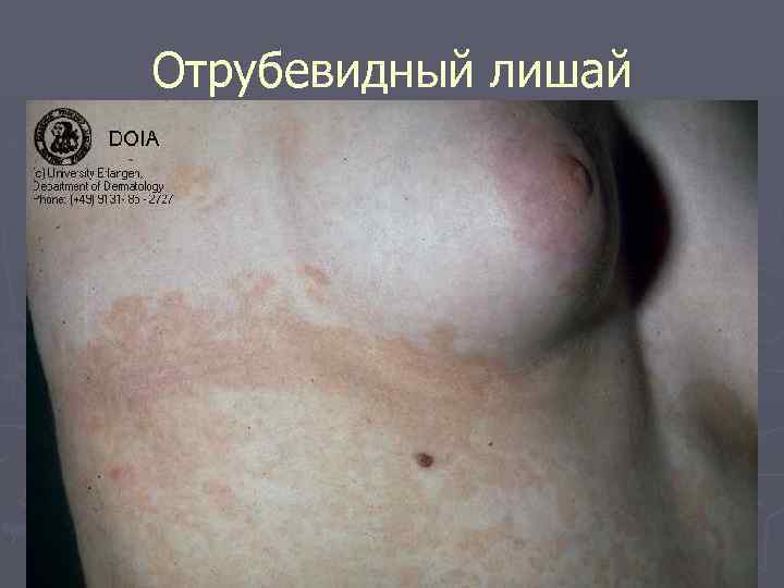 Отрубевидный лишай 