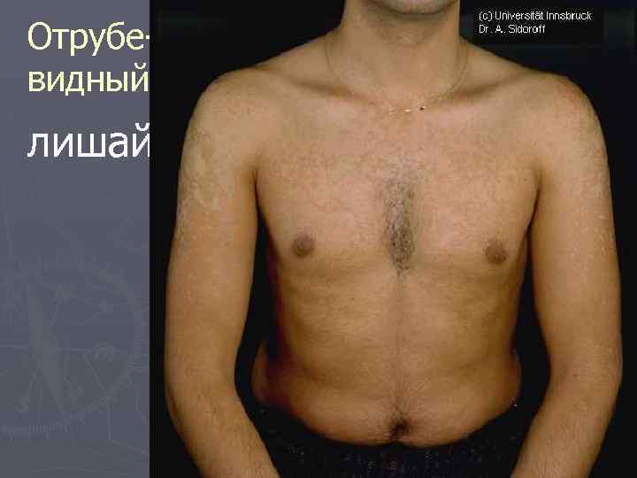 Отрубевидный лишай 