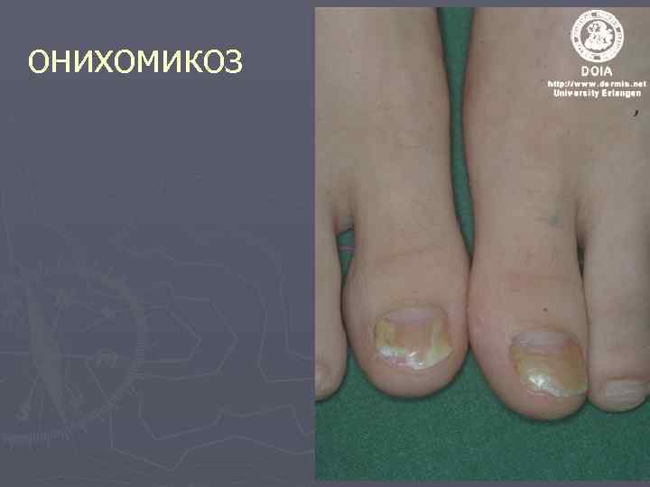 онихомикоз 