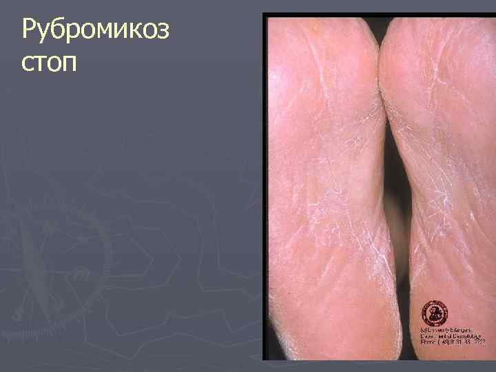 Рубромикоз стоп 