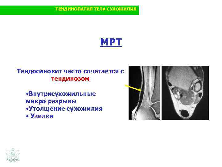 ТЕНДИНОПАТИЯ ТЕЛА СУХОЖИЛИЯ МРТ Тендосиновит часто сочетается с тендинозом • Внутрисухожильные микро разрывы •