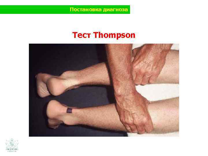 Постановка диагноза Тест Thompson 