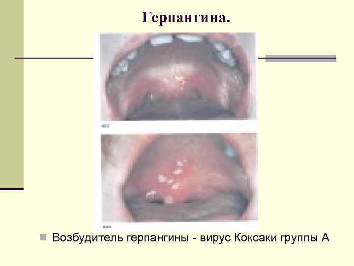Герпангина. n Возбудитель герпангины - вирус Коксаки группы А 