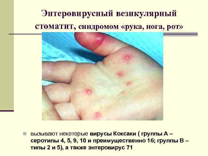 Энтеровирусный везикулярный стоматит, синдромом «рука, нога, рот» n вызывают некоторые вирусы Коксаки ( группы