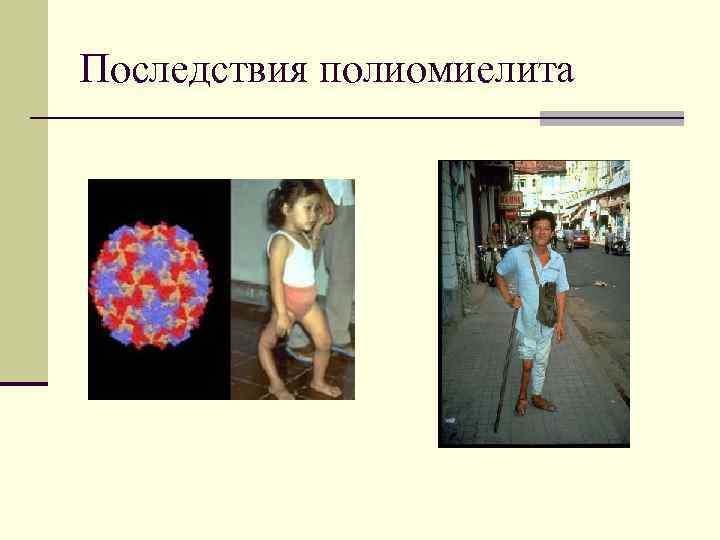 Последствия полиомиелита 