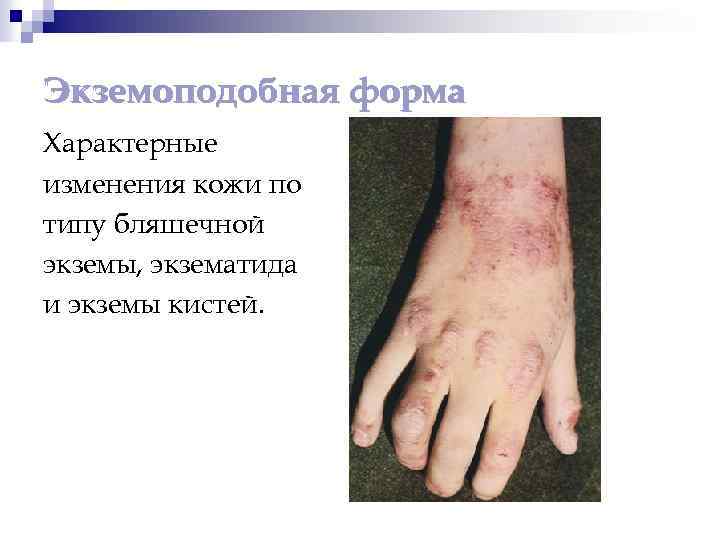 Экземоподобная форма Характерные изменения кожи по типу бляшечной экземы, экзематида и экземы кистей. 