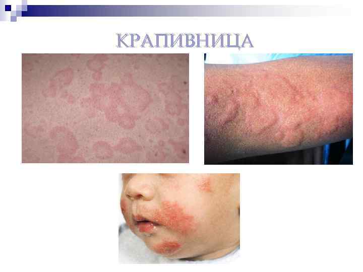 КРАПИВНИЦА 