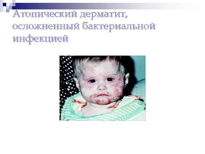 Атопический дерматит, осложненный бактериальной инфекцией 