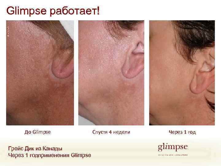 Glimpse работает! До Glimpse Грейс Дик из Канады Через 1 годприменения Glimpse Спустя 4