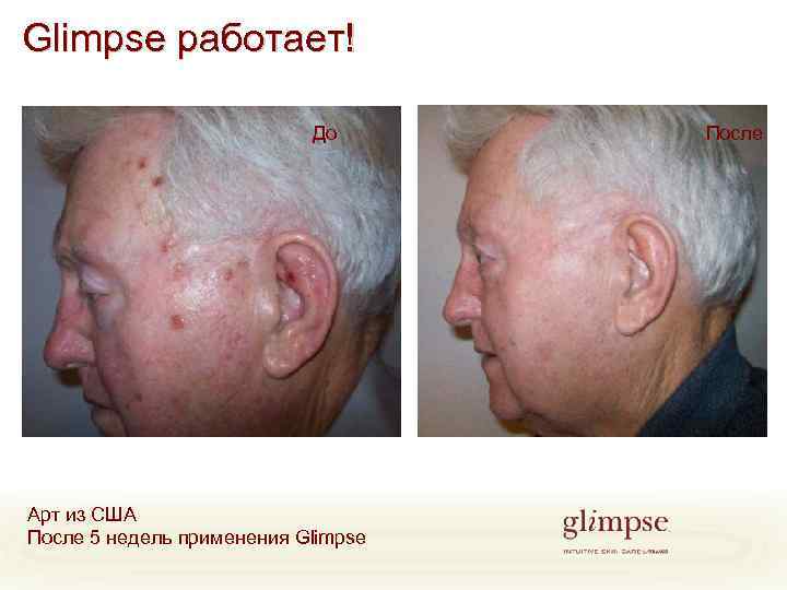 Glimpse работает! До Арт из США После 5 недель применения Glimpse После 