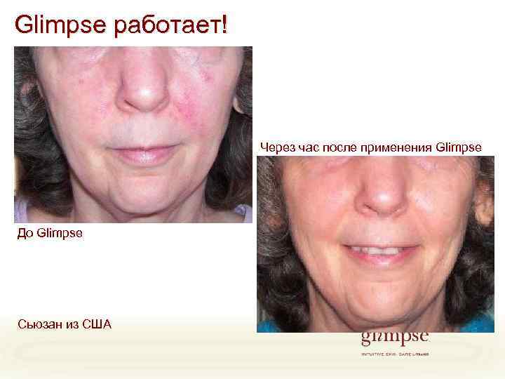 Glimpse работает! Через час после применения Glimpse До Glimpse Сьюзан из США 