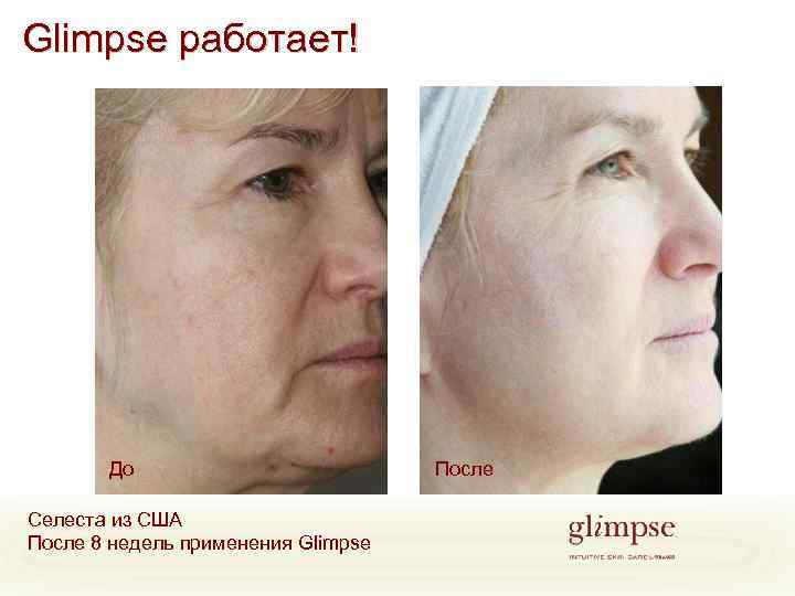 Glimpse работает! До Селеста из США После 8 недель применения Glimpse После 