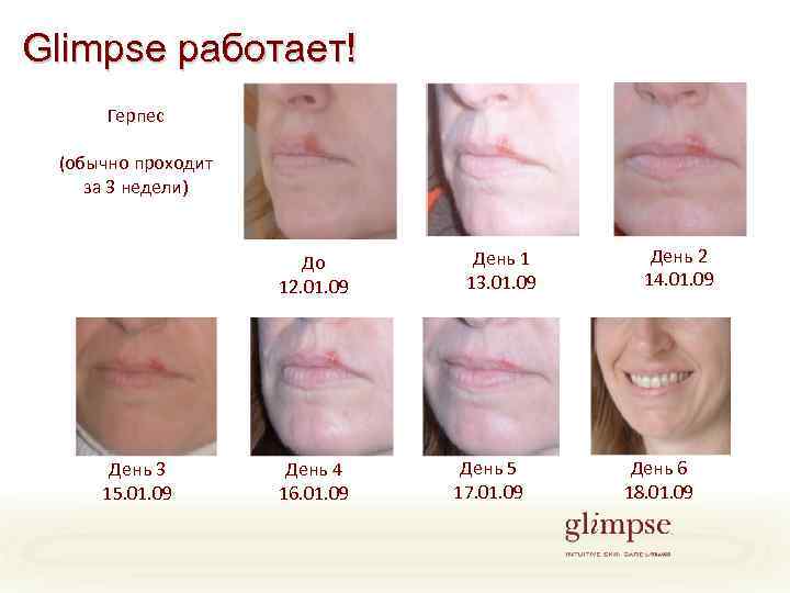 Glimpse работает! Герпес (обычно проходит за 3 недели) До 12. 01. 09 День 3