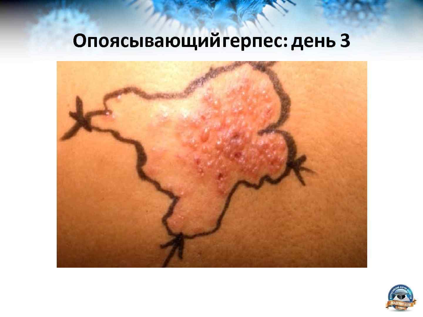 Опоясывающийгерпес: день 3 